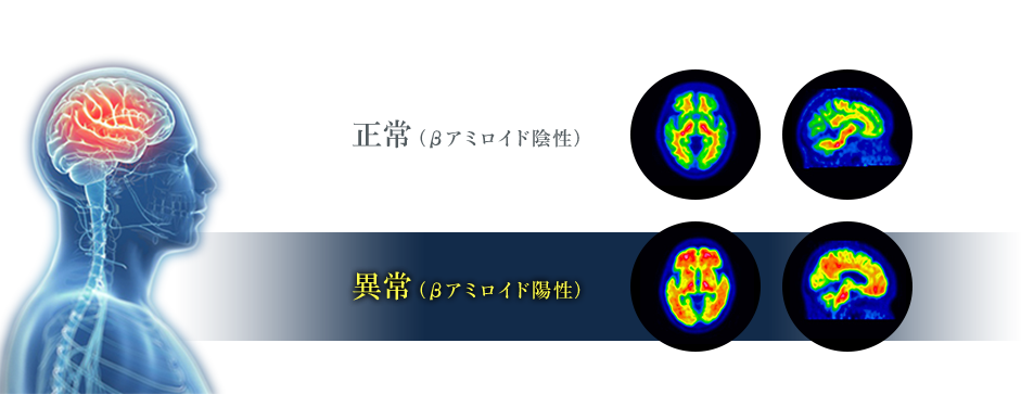 脳のβアミロイド沈着を画像イメージ化