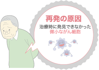 再発の原因　治療時に発見できなかった微小ながん細胞