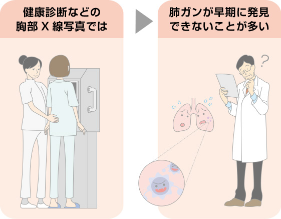 レントゲンでは肺がん早期発見が難しい