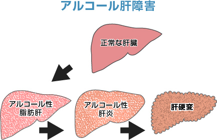 肝臓と肝硬変、がん